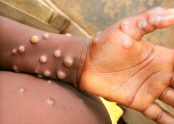 Haut-Katanga : Aucun cas de Mpox détecté à ce Jour, annonce le Ministre provincial de la Santé