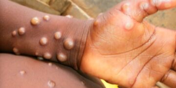 Haut-Katanga : Aucun cas de Mpox détecté à ce Jour, annonce le Ministre provincial de la Santé